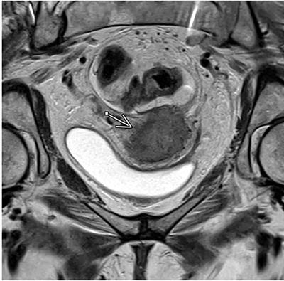 Utilization of functional MRI in the diagnosis and management of cervical cancer